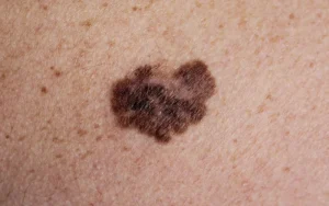 A Melanoma Mole
