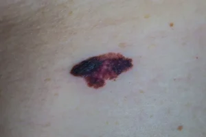 A Multi-coloured Mole